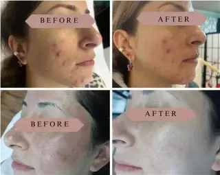 FACIAL LIMPIEZA PROFUNDA
