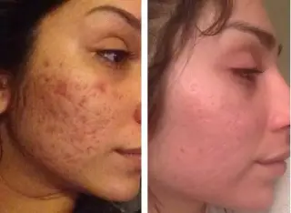 FACIAL LIMPIEZA PROFUNDA