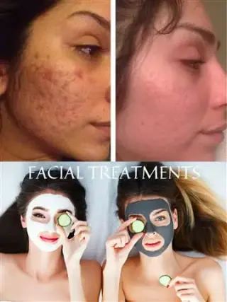 FACIAL ACNE LIMPIEZA PROFUNDA