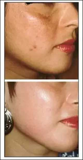 FACIAL ACNE LIMPIEZA PROFUNDA