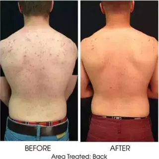 ACNE FACIAL WAX MASSAGE SCRUB