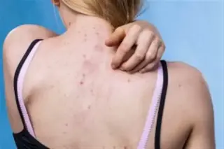 ACNE FACIAL WAX MASSAGE SCRUB