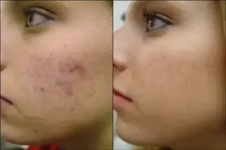 FACIAL ELIMINA CELULAS MUERTAS