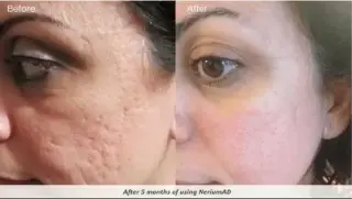 FACIAL ELIMINA CELULAS MUERTAS