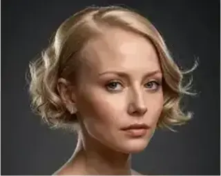Alopecia Tratamientos
