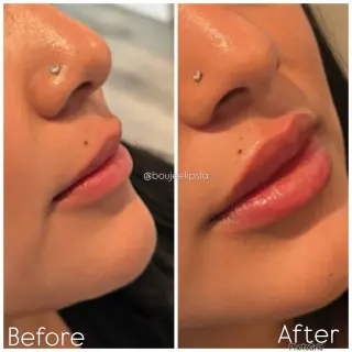 Consigue los labios de tus sueños sin dolor ni agujas!