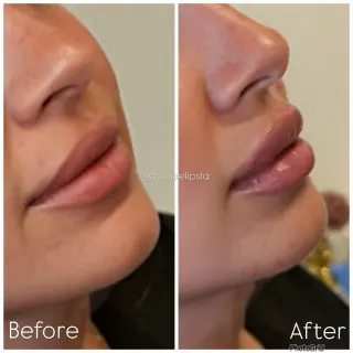 Consigue los labios de tus sueños sin dolor ni agujas!