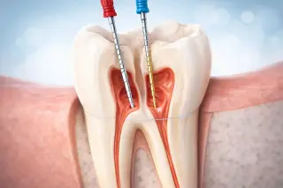 🦷 Tratamiento de Conducto (Root Canal) en Pico Rivera — Smile Avenue Dental Gr