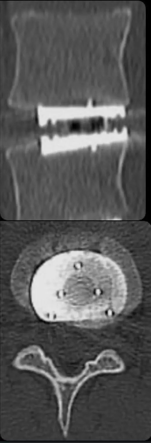 Artificial Disc Replacement Surgeon