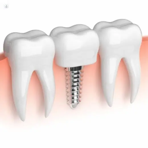 Implantes Dentales en MEXICO