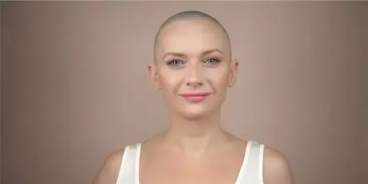 Pérdida de Cabello por Quimo