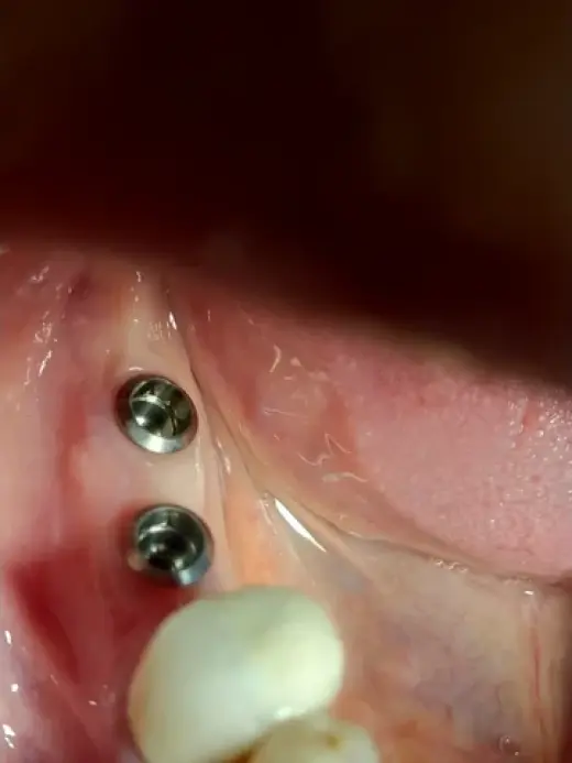 IMPLANTES DENTALES NACIONALES