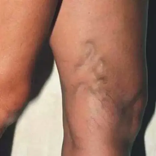 ¿VÁRICES EN LAS PIERNAS?