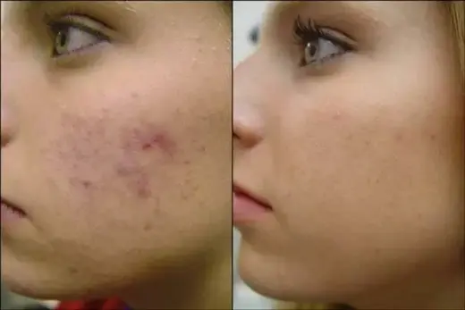 FACIAL ELIMINA CELULAS MUERTAS