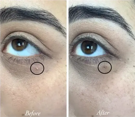 ¿Tienes verrugas irritados?