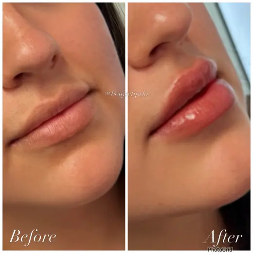Consigue los labios de tus sueños sin dolor ni agujas!